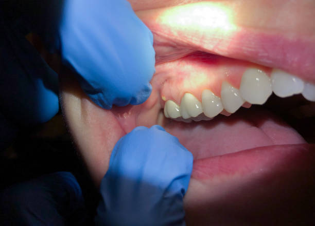 Best Emergency Dental Care for Broken or Chipped Teeth in Hudson Bend, TX